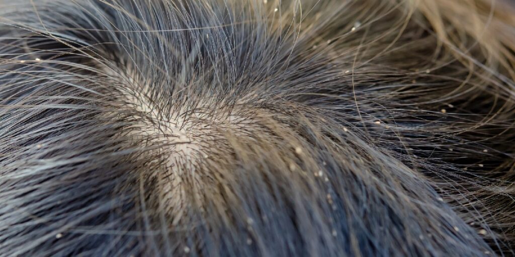 lice eggs