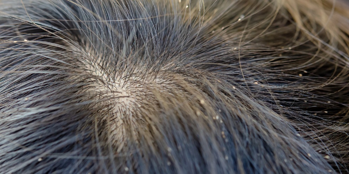 Why Are Head Lice Eggs So Hard to Remove?